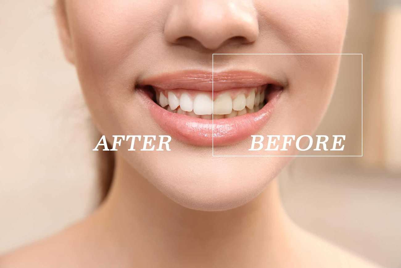 How Can You Maintain a Consistent Smile Shade with Crowns Purley?