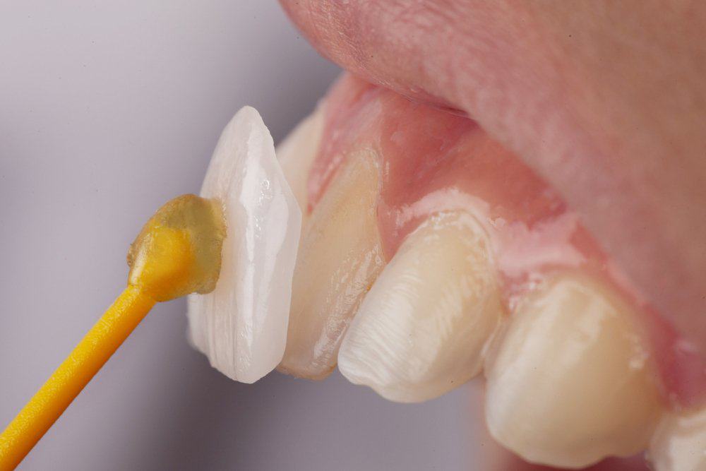 Dental Veneers: Achieving a Flawless Look Purley