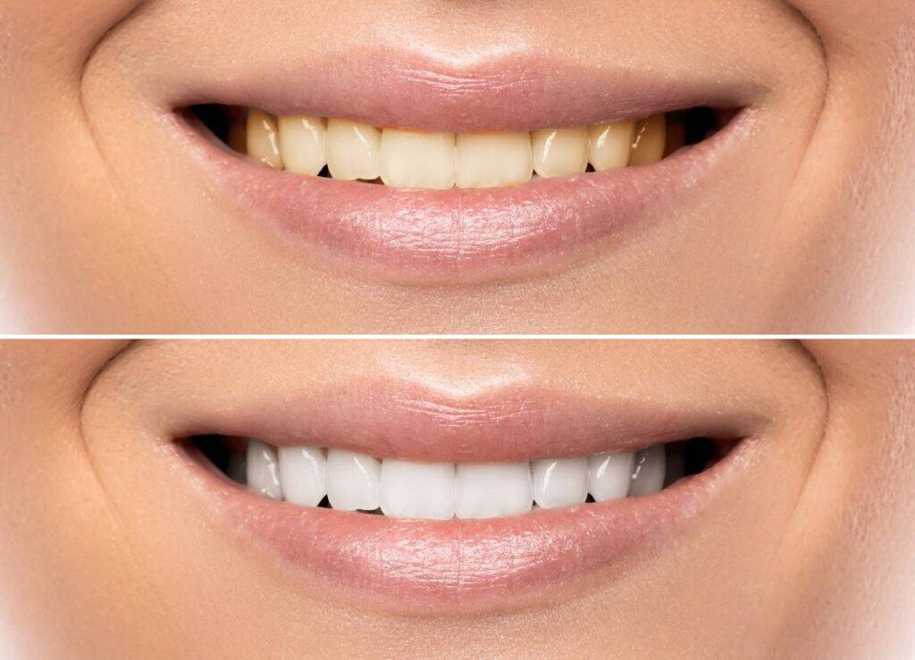 How Does Gum Disease Progress if Left Untreated Purley?