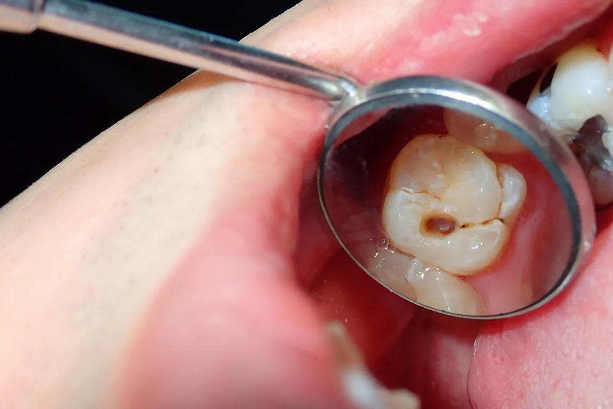 Why Do Teeth Crack? Common Causes to Know Purley