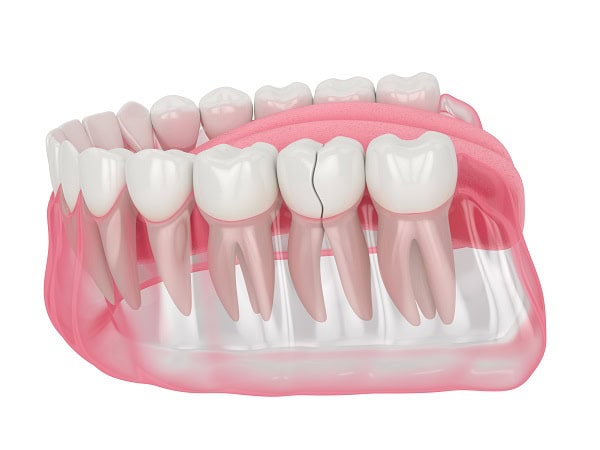 How Can You Manage Pain and Discomfort After a Root Canal Purley?