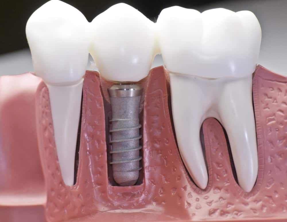 Common Misconceptions About Modern Dental Treatments Purley