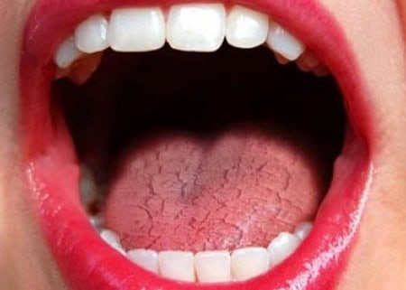 Common Causes of Dry Mouth (Xerostomia) Purley