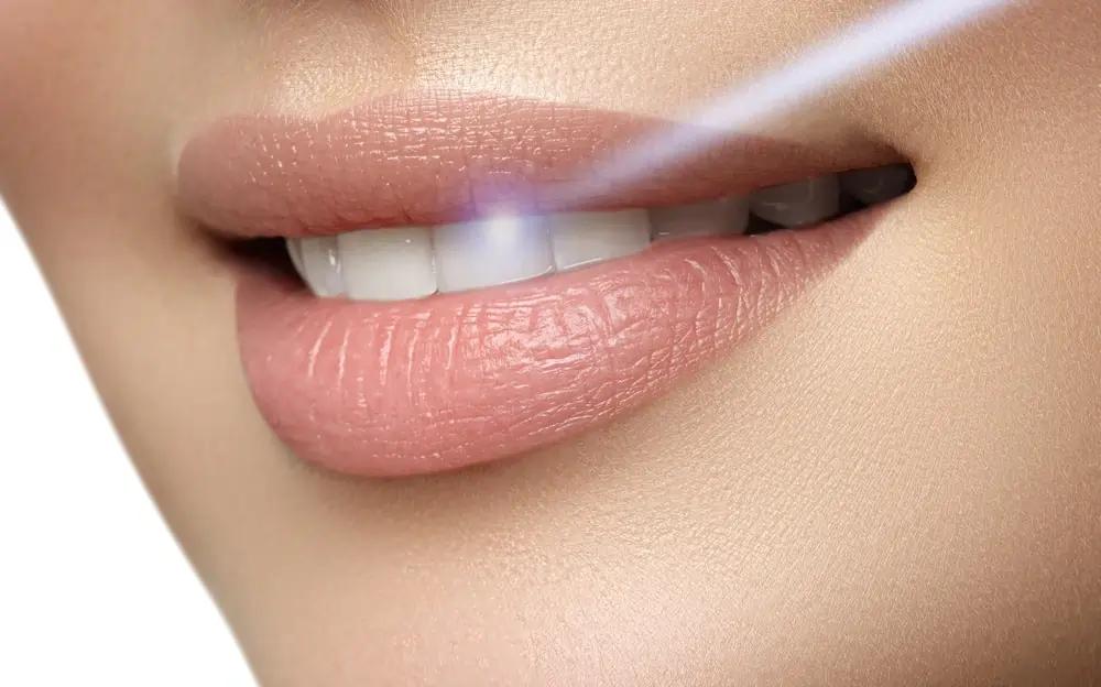 How Long Does Laser Teeth Whitening Last on Your Teeth Purley?