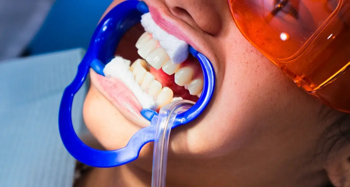 Is Laser Teeth Whitening Worth the Investment Purley?