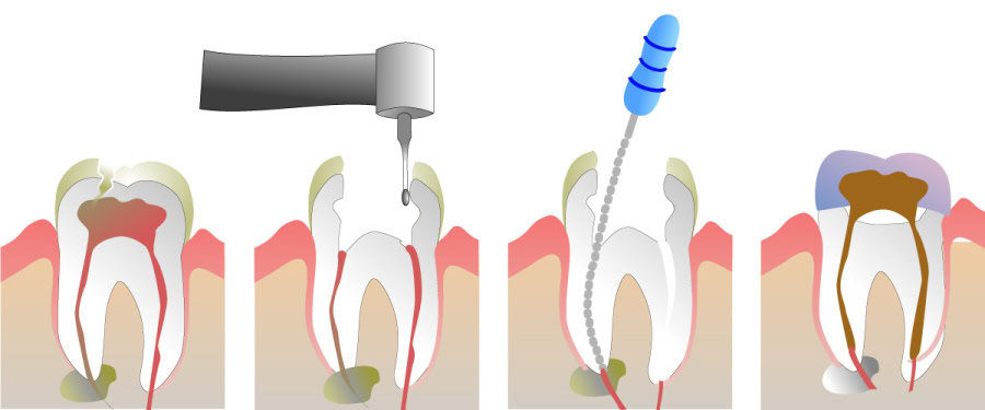 How Do You Properly Care for Your Teeth After a Root Canal Purley