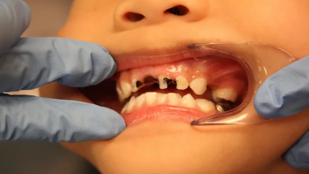 Tips for Keeping Your Child’s Baby Teeth Healthy and Strong Purley
