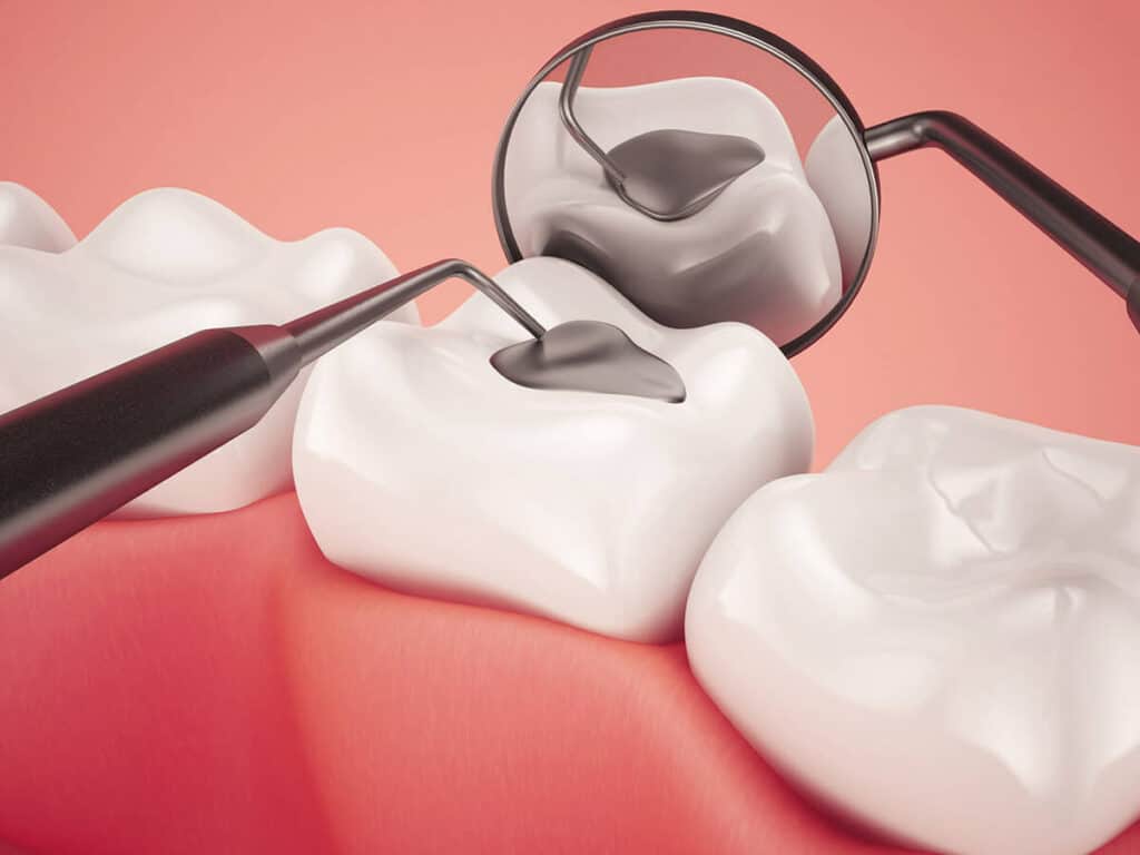 How Can You Prevent Tooth Decay Effectively Purley
