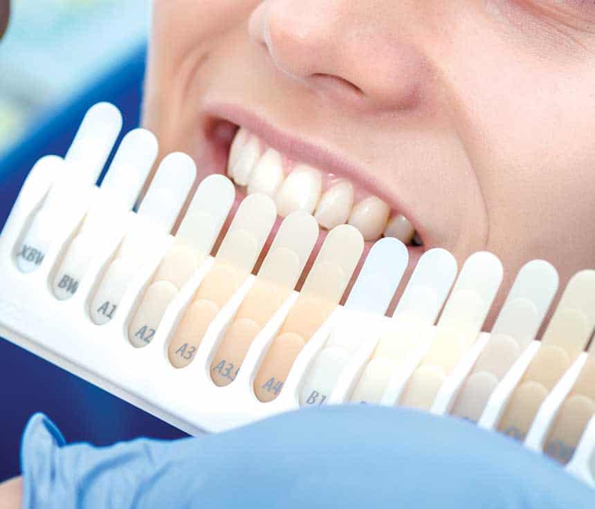 Is Laser Teeth Whitening Worth It for a Brighter, Confident Smile Purley?