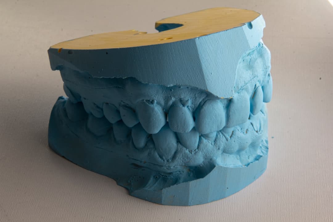 How Do Dental Implants Improve Jawbone Health and Oral Function Purley?