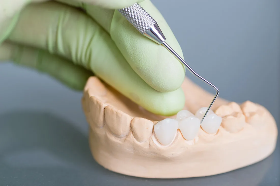 Do Braces Take Years to Show Results Purley