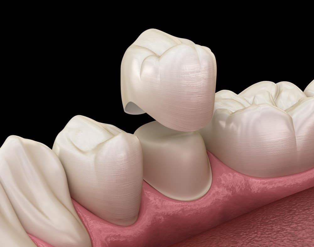Teeth Whitening: Separating Facts from Fiction Purley