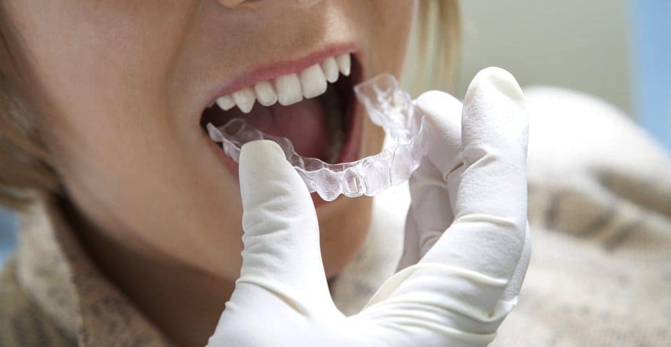 Why Bleaching Trays Require More Time Purley